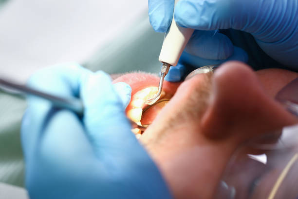 Best Broken or Chipped Tooth Repair in Due West, SC