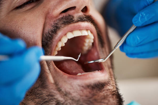 Best Emergency Wisdom Tooth Extraction in Due West, SC